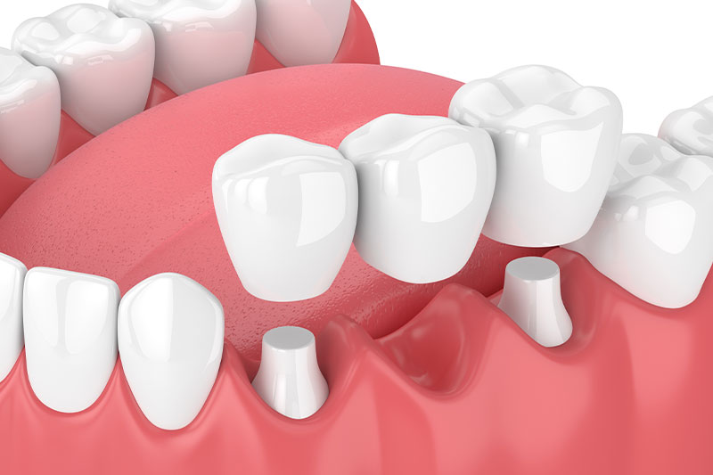 Quality Dental Treatments in Altamonte Springs