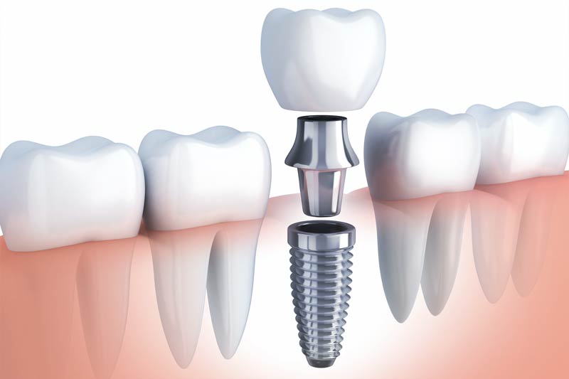 Dental Implant in Altamonte Springs