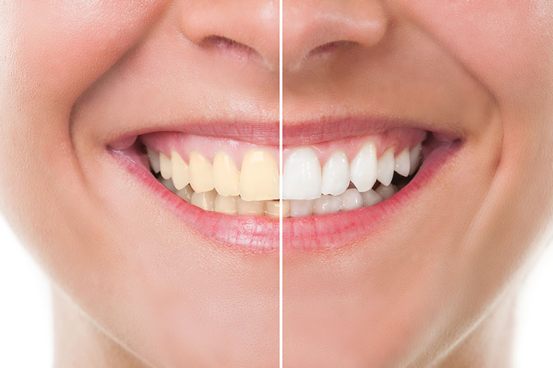 Quality Dental Treatments in Altamonte Springs