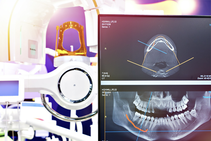 3D Cat Scan for Dental Implant Placement in Altamonte Springs