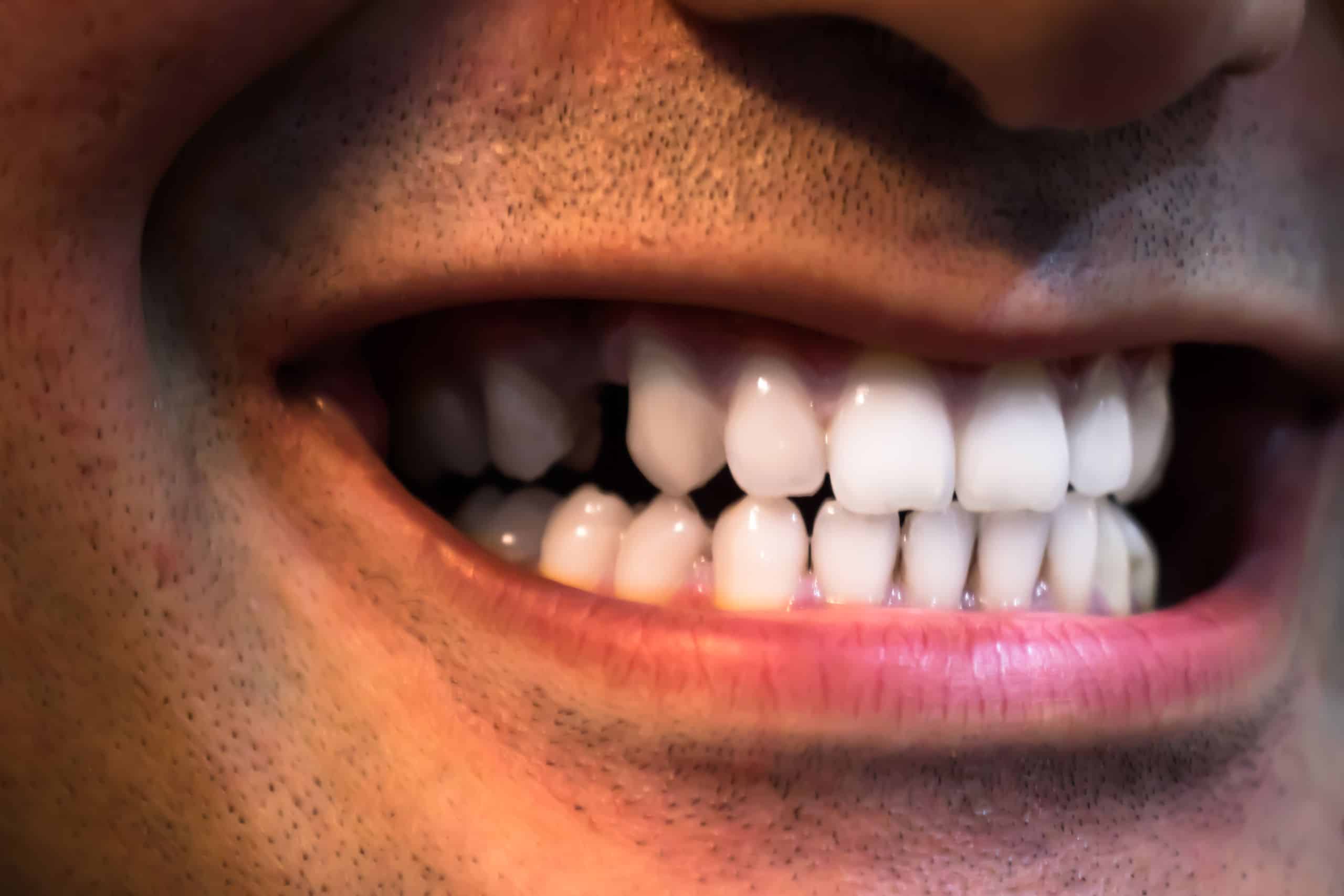 The man's tooth is broken, and he is checking whether it can be reattached or not.