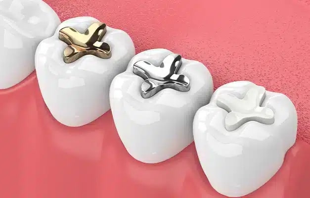 Dental fillings served by general dentist at Altamonte Springs