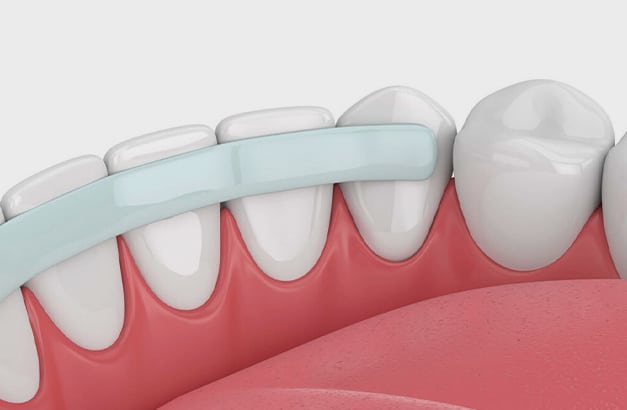 Procedure of cosmetic dental bonding at Altamonte Springs